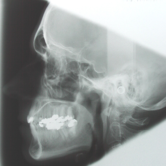 x-ray side